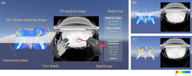 20230521-赢博手机版app医学院博士生张楠、杨讷与李阳曦在中国生物医学工程大会暨创新医疗峰会上获奖-张楠-基于三维空间交互的宫颈癌靶区勾画虚拟现实环境总览.jpg